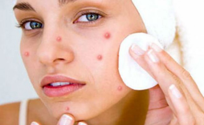 Pimples-on-Face