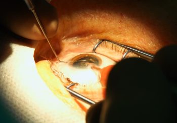 जुम्लामा सम्पन्न आँखा शिविरमा १७६ जनाको शल्यक्रिया