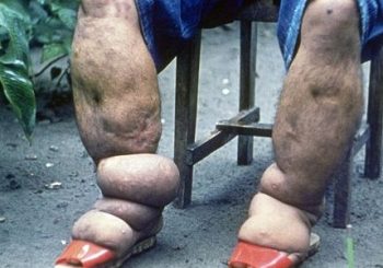 हात्तीपाइले रोगको संक्रमण दर पत्ता लगाउन सर्वेक्षण