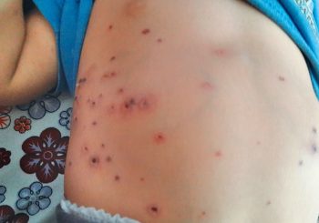 जुम्राबाट  स्क्रब टाइफस