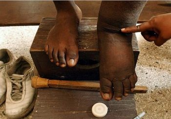 हात्तिपाइले विरुद्धको औषधि सेवन अभियान प्रभावकारी हुन सकेन,रोग उन्मूलनको लक्ष्य पूरा गर्न कठीन