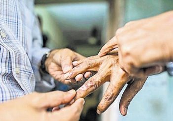 सुदूरपश्चिम प्रदेशमा कुष्ठरोगीको संख्या बढ्दै