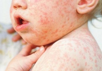 विश्वभर दादुराको संक्रमण तीन गुणा बढ्योः डब्लुएचओ